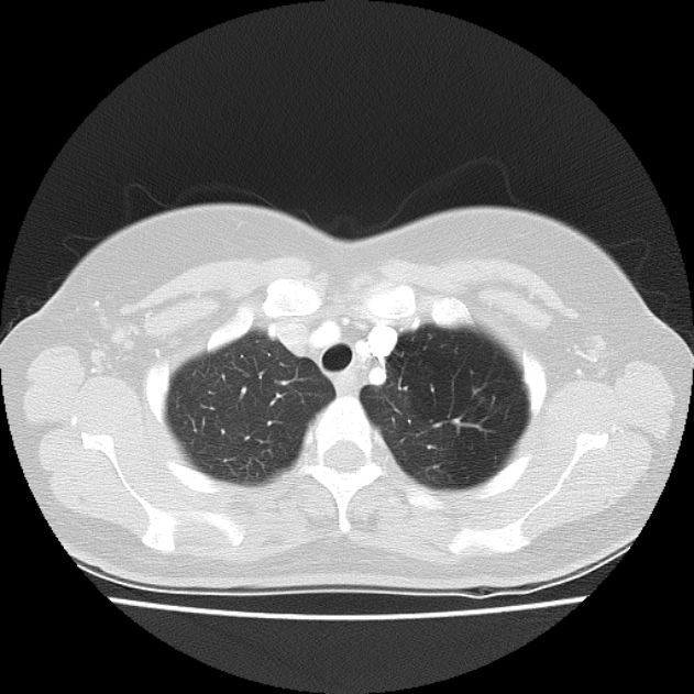 Bronchial atresia (Radiopaedia 22965-22992 Axial lung window 43).jpg