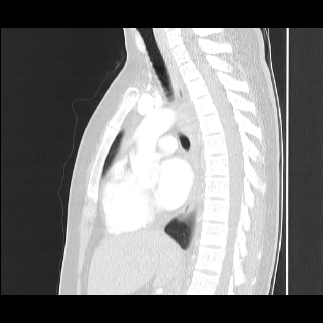 Bronchial atresia (Radiopaedia 22965-22992 Sagittal lung window 28).jpg