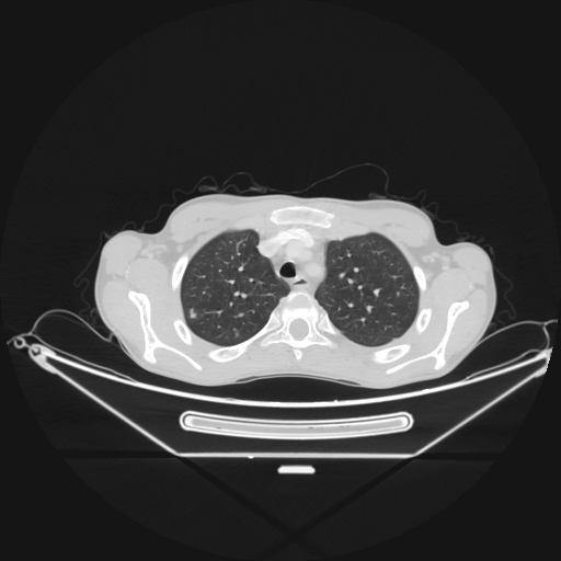 Bronchial carcinoid tumor (Radiopaedia 57187-64090 Axial lung window 14).jpg