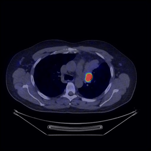Bronchial carcinoid tumor (Radiopaedia 67377-76765 68Ga-DOTATATE PET-CT 28).jpg