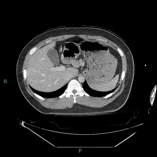 Bronchial carcinoid tumor (Radiopaedia 78272-90870 C 115).jpg