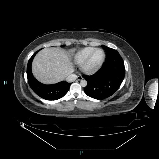 File:Bronchial carcinoid tumor (Radiopaedia 78272-90870 C 91).jpg