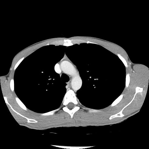 File:Bronchial carcinoid tumor causing right lower lobe collapse (Radiopaedia 83495-98594 A 14).jpg