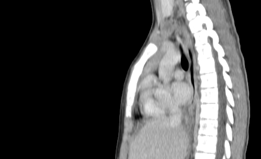 Bronchial mucoepidermoid carcinoma (Radiopaedia 57023-63895 Sagittal 119).jpg