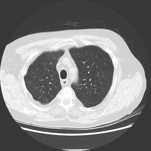 Bronchial stenosis - lung transplant (Radiopaedia 73133-83848 Axial lung window 17).jpg