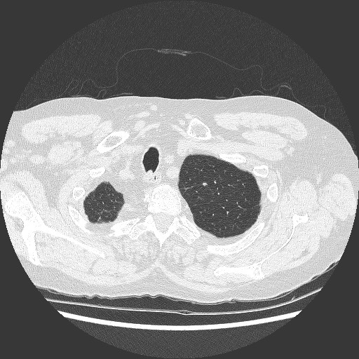 File:Bronchial stenosis - lung transplant (Radiopaedia 73133-83848 C 2).jpg