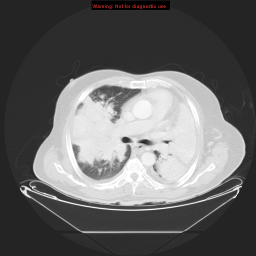 File:Bronchioloalveolar carcinoma (Radiopaedia 9272-9955 Axial lung window 14).jpg
