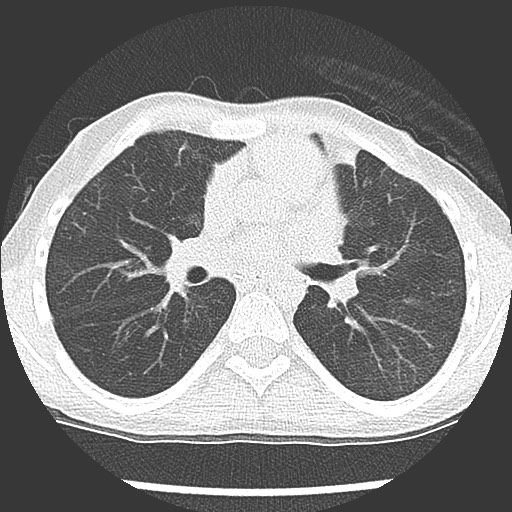File:Bronchiolotis obliterans (Radiopaedia 73769-84575 Axial lung window 23).jpg