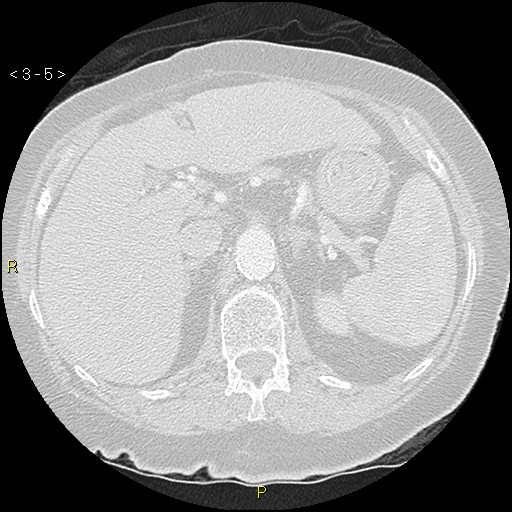File:Bronchogenic carcinoma as an incidental finding (Radiopaedia 16453-16130 Axial lung window 5).jpg
