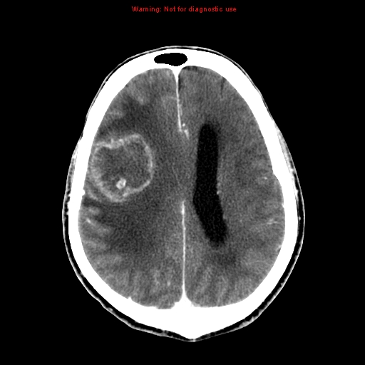 File:Bronchogenic carcinoma brain metastasis (Radiopaedia 9286-9970 B 19).jpg