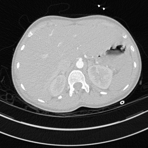 Bronchogenic cyst (Radiopaedia 77801-90071 Axial lung window 85).jpg