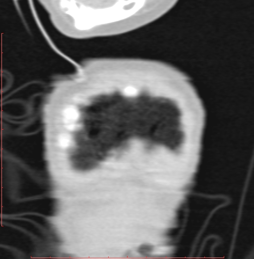 Bronchogenic cyst (Radiopaedia 78599-91409 Coronal lung window 12).jpg