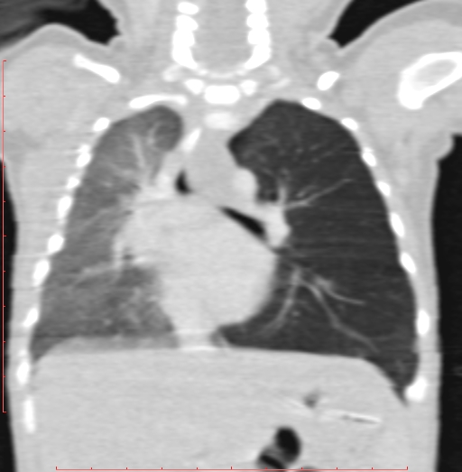 Bronchogenic cyst (Radiopaedia 78599-91409 Coronal lung window 126).jpg