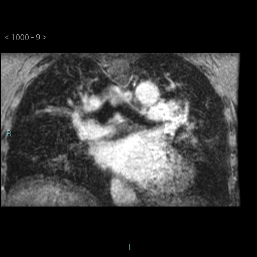 File:Bronchogenic cyst - posterior mediastinal (Radiopaedia 43885-47365 Coronal T1 C+ 8).jpg