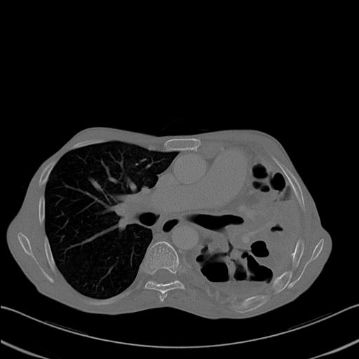 File:Bronchopleural fistula secondary to tuberculosis (Radiopaedia 20415-20322 Axial bone window 14).jpg