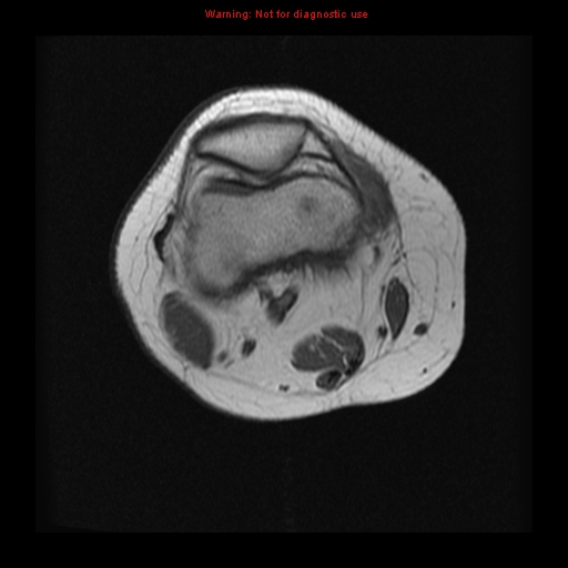 File:Brown tumor (Radiopaedia 12318-12597 Axial T1 3).jpg