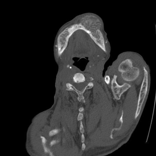 File:Brown tumor with secondary hyperparathyroidism (Radiopaedia 23591-23705 C 8).jpg