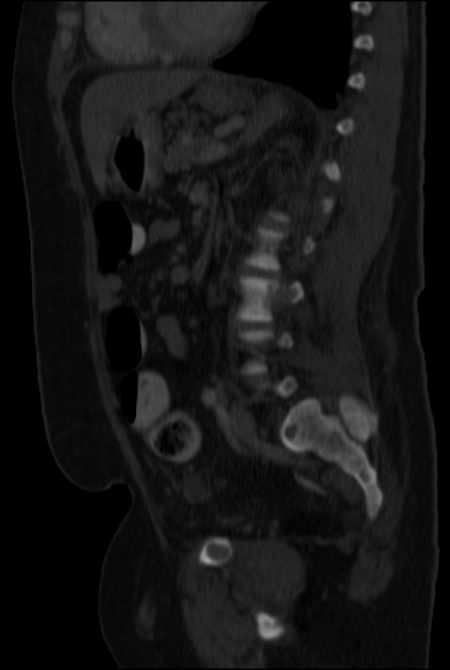 Brown tumors compressing the spinal cord (Radiopaedia 68442-77988 H 34).jpg