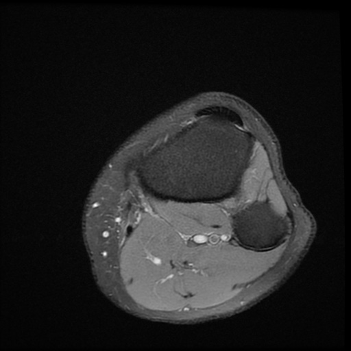 File:Bucket-handle meniscus tear (Radiopaedia 65700-74809 Axial PD fat sat 25).jpg