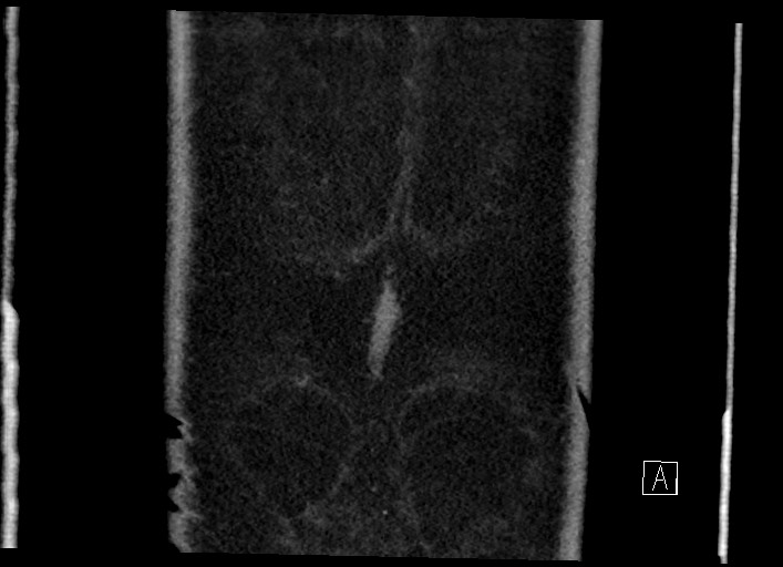 Buried bumper syndrome - gastrostomy tube (Radiopaedia 63843-72577 Coronal Inject 145).jpg