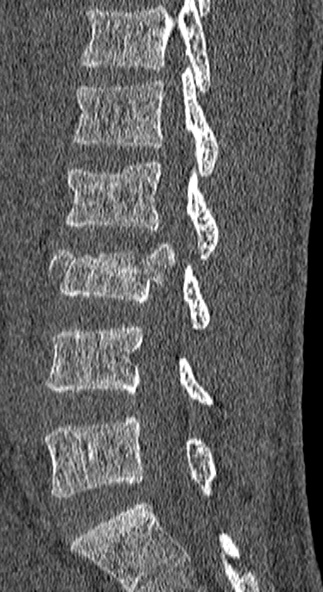 Burst fracture (Radiopaedia 53373-59357 Sagittal bone window 41).jpg