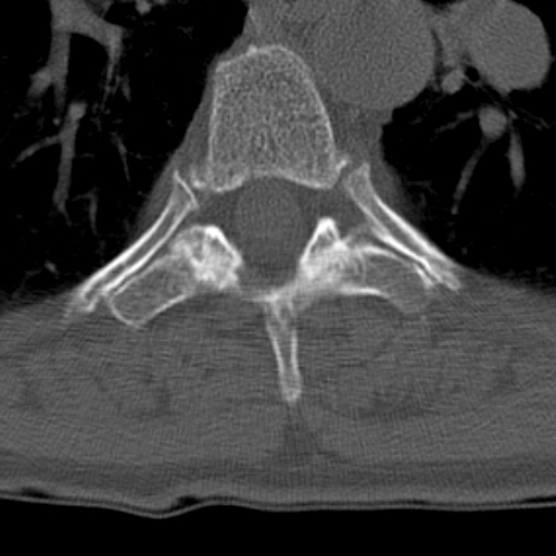 Butterfly vertebrae with kyphoscoliosis (Radiopaedia 14257-14133 Axial bone window 3).jpg