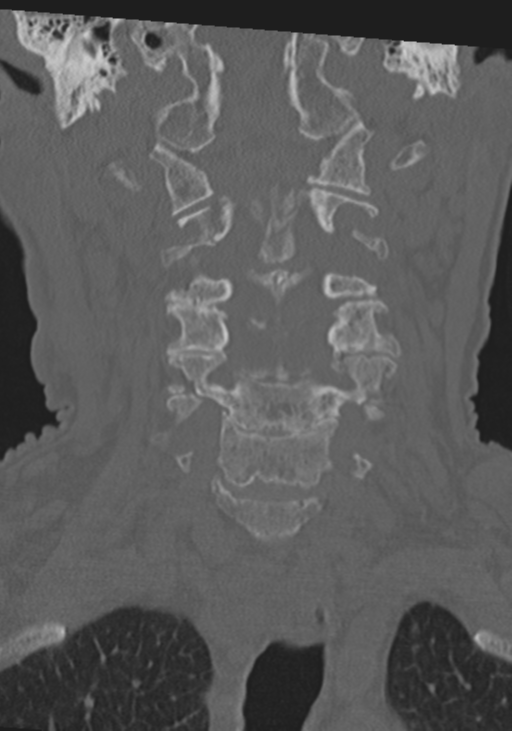 C2 fracture with vertebral artery dissection (Radiopaedia 37378-39199 Coronal bone window 17).png