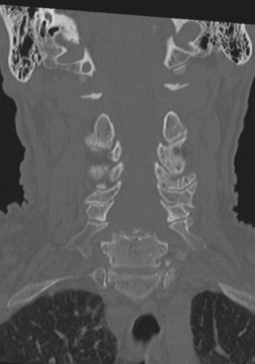 C2 fracture with vertebral artery dissection (Radiopaedia 37378-39199 Coronal bone window 24).png
