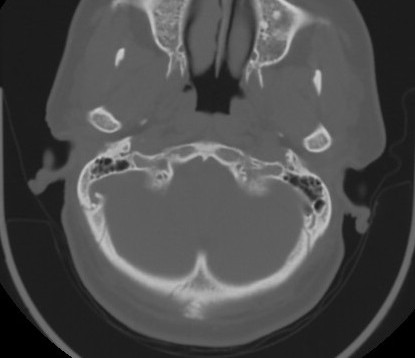 C7 laminar fracture and Klippel-Feil syndrome (Radiopaedia 86710-102850 Axial bone window 17).jpg