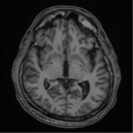 CNS vasculitis (Radiopaedia 55715-62263 Axial T1 23).png