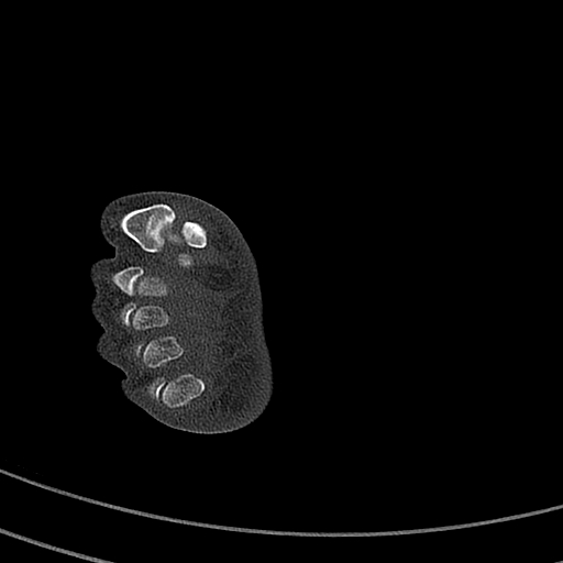 Calcaneal fracture - Sanders type 4 (Radiopaedia 90179-107370 Axial bone window 60).jpg