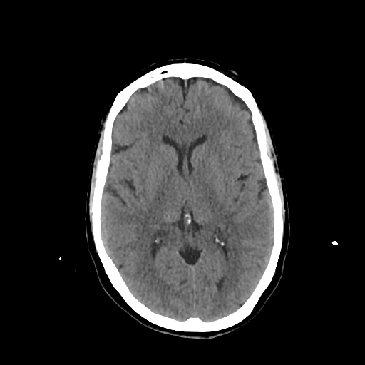File:Calcified meningioma - cervical canal (Radiopaedia 70136-80171 Axial non-contrast 14).jpg
