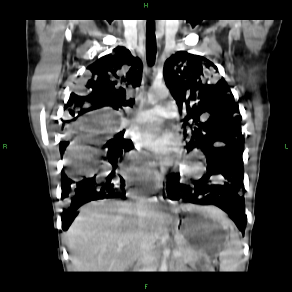 File:Cannon ball metastases - synovial sarcoma (Radiopaedia 26135-26271 Coronal liver window 8).jpg