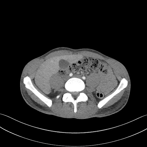 Cannonball metastases - testicular choriocarcinoma (Radiopaedia 84510-99891 B 152).jpg