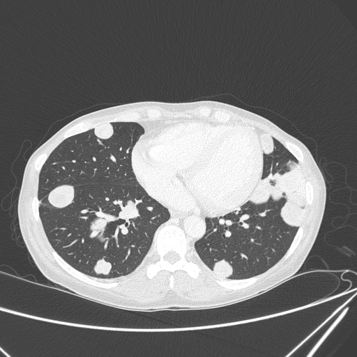 Canonball lung metastasis (Radiopaedia 77634-89837 Axial lung window 123).jpg