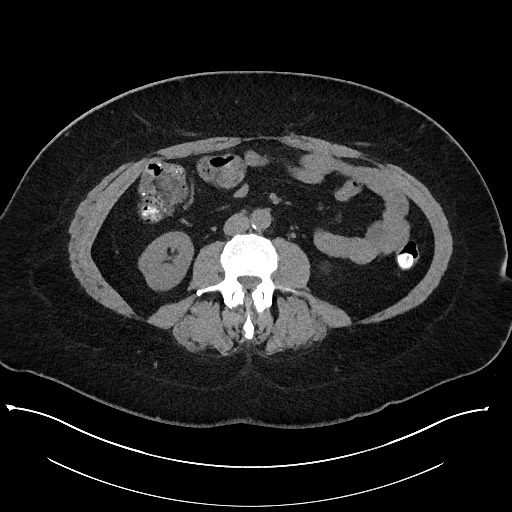 Carcinoid tumor - terminal ileum (Radiopaedia 60931-68740 Axial non-contrast 59).jpg