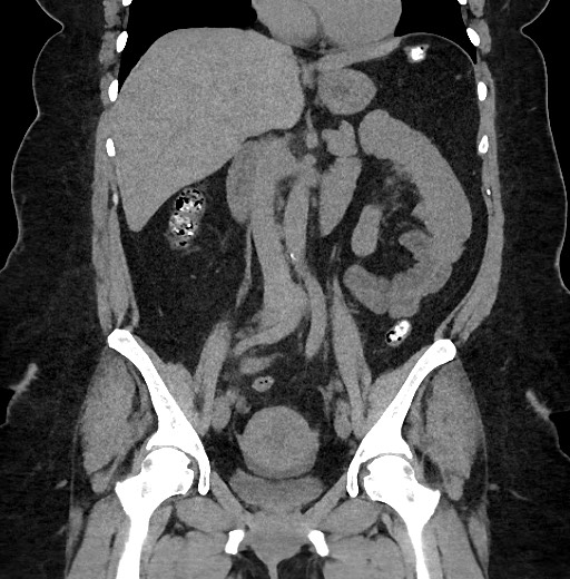 Carcinoid tumor - terminal ileum (Radiopaedia 60931-68740 Coronal non-contrast 51).jpg