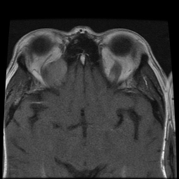 File:Carcinoid tumor of the ileum with metastasis to orbit (Radiopaedia 28165-28424 Axial T1 15).jpg