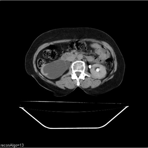 File:Carcinoma cervix- recurrence (Radiopaedia 34702-36137 Axial C+ delayed 12).jpg