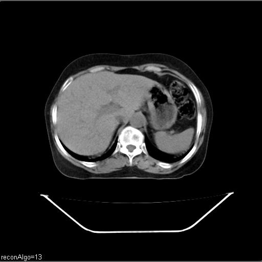 File:Carcinoma cervix- recurrence (Radiopaedia 34702-36137 Axial non-contrast 11).jpg