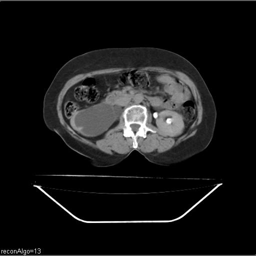 Carcinoma cervix- recurrence (Radiopaedia 34702-36137 B 74).jpg