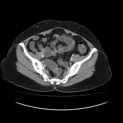 Carcinoma colon - hepatic flexure (Radiopaedia 19461-19493 A 103).jpg