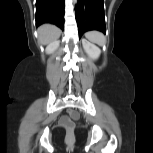File:Carcinoma colon - hepatic flexure (Radiopaedia 19461-19493 B 31).jpg