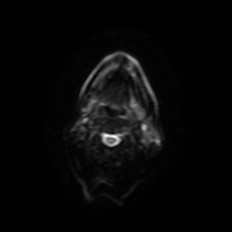 Carcinoma ex-pleomorphic adenoma of parotid (Radiopaedia 28383-28627 Ax DWI B-500 GE 10).jpg