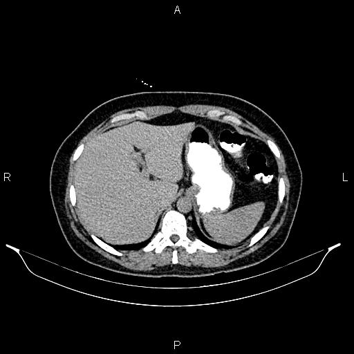 File:Carcinoma of uterine cervix (Radiopaedia 85861-101700 Axial C+ delayed 3).jpg