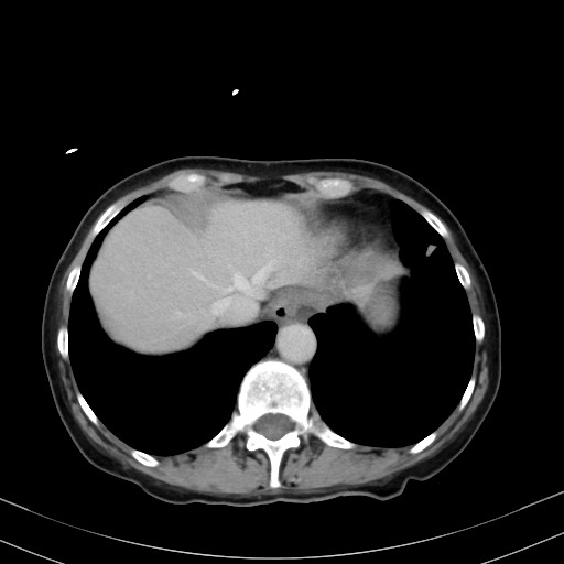 Carcinosarcoma (Radiopaedia 70401-80503 A 8).jpg