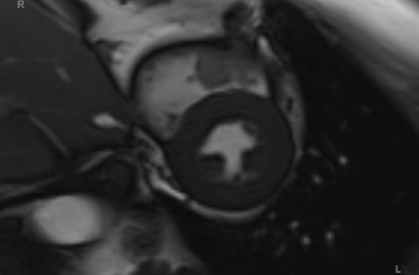 Cardiac hemangioma (Radiopaedia 31709-32631 Short axis Cine SSFP 9).jpg