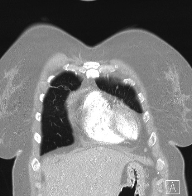 Cardiac sarcoidosis (Radiopaedia 74548-85534 Coronal lung window 8).jpg