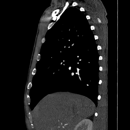 Cardiac tumor - undifferentiated pleomorphic sarcoma (Radiopaedia 45844-50134 B 59).png