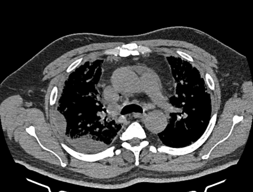 Cardiogenic pulmonary edema (Radiopaedia 68180-77678 Axial non-contrast 15).jpg